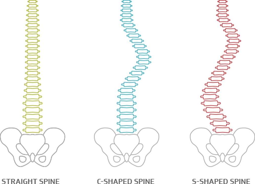 Voorbeelden van de wervelkolom bij iemand die scoliose heeft